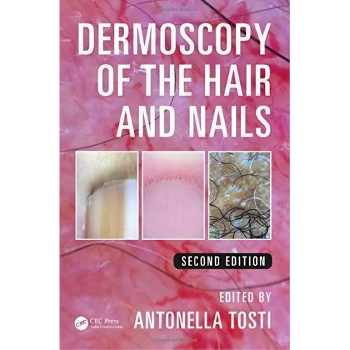 Dermoscopy Of The Hair And Nails, De Antonella Tosti. Editorial Apple Academic Press Inc. En Inglés