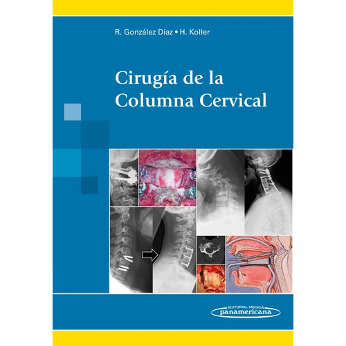 Cirugía De La Columna Cervical Gonzalez