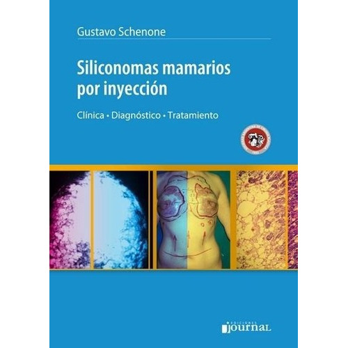 Siliconomas Mamarios Por Inyección Schenone