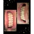 Carilla Dental En Resina (precio Por Unidad)