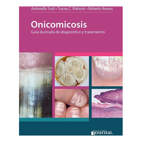 Onicomicosis Guia Ilustrada De Diagnostico Y Tratamiento