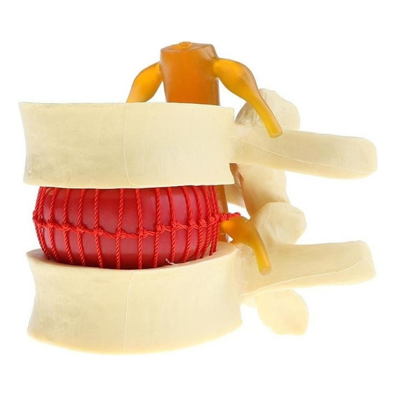 2x Modelo De Hernia De Disco Lumbar De La Columna Vertebral