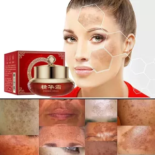 Crema De Sangre De Dragón Elimina Paño Manchas Melasma Tipo De Piel Todo Tipo De Piel