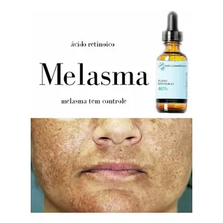 Tratamento Melasma (retinoico 10ml + Tca 10ml)