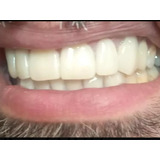 Carillas Dentales Esteticas