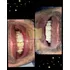 Carilla Dental En Resina (precio Por Unidad)