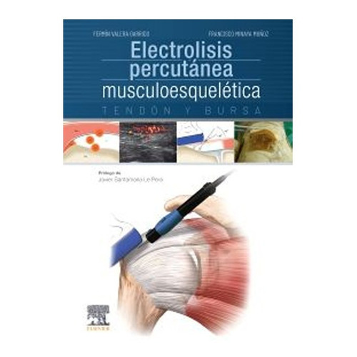 Electrolisis Percutánea Musculoesquelética Tendón Y Bursa