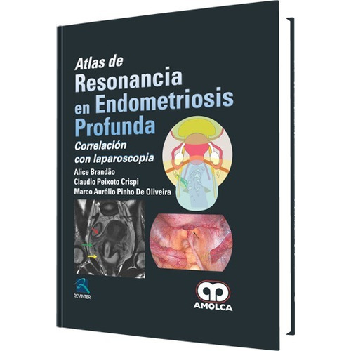 Atlas De Resonancia En Endometriosis Profunda Laparoscopia
