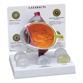 Modelo De Ojo Humano Educativo Aumentado 3x Catarata 