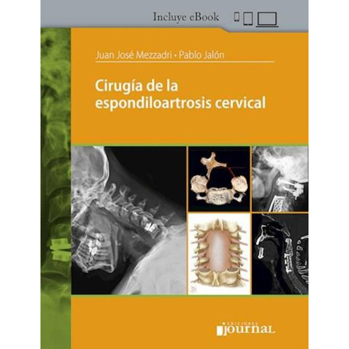 Cirugia De La Espondiloartrosis Cervical
