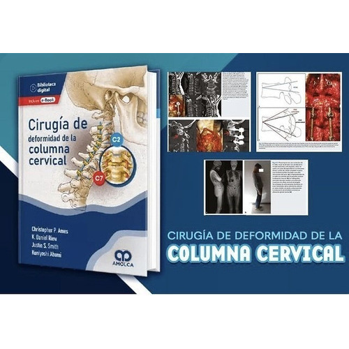 Cirugía De Deformidad De La Columna Cervical +e-book, De C.p Ames Y S., Vol. 1. Editorial Amolca, Tapa Dura, Edición 1 En Español, 2022