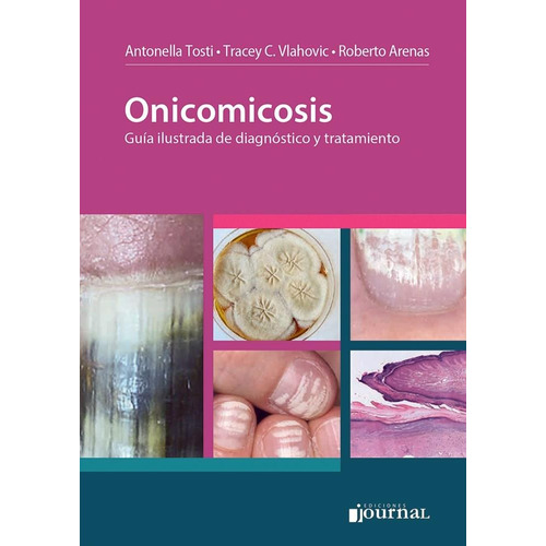 Onicomicosis Guia Ilustrada De Diagnostico Y Tratamiento
