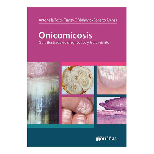 Onicomicosis Guía Ilustrada De Diagnostico Y Tratamiento 