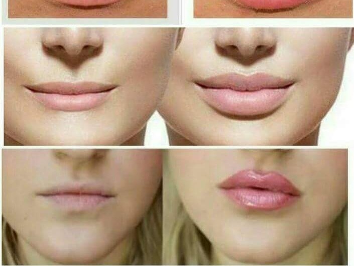 Resultado de imagen para acido hialuronico labios