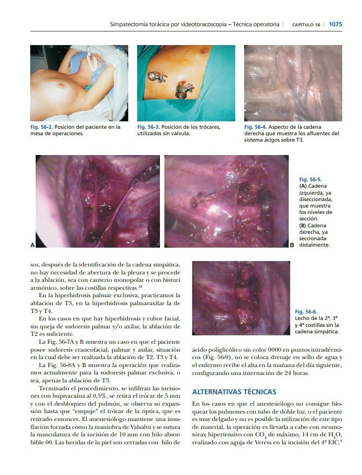 El aumento del tono de los vasos el levantamiento varikoza