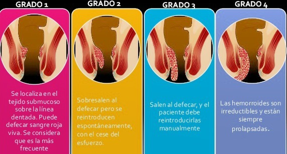 Cuanto cuesta una operación de hemorroides en españa