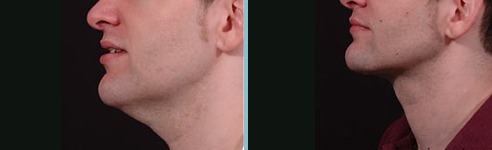 Faixa Cinta Facial Creme Redutor Papada Queixo Duplo R 6900 Em