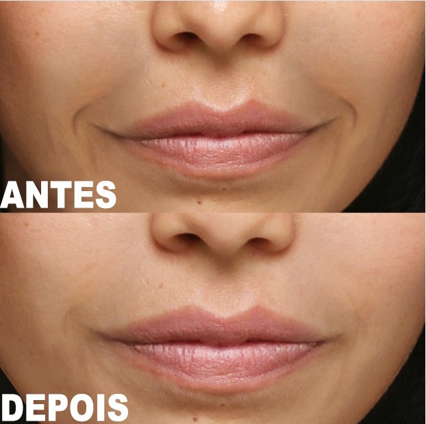 bottox caps preço