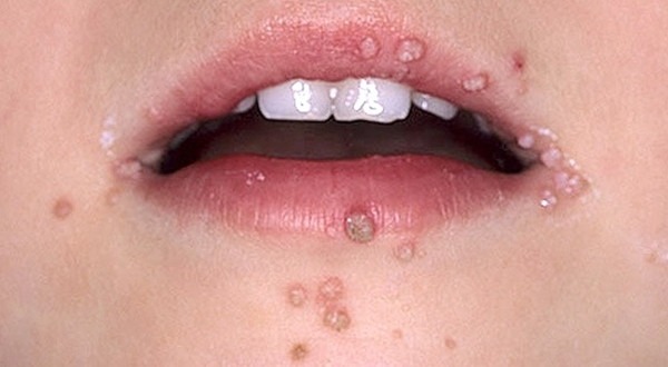 Kit Elimina Verrugas Vph Con Supervisión Hasta Que Te Kit Elimina Verrugas Vph Con Supervisión Hasta Que Te