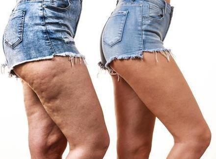 Kit Perfect Legs + Cellu Control + Stretch Marks Idraet - $ 3.713 ...