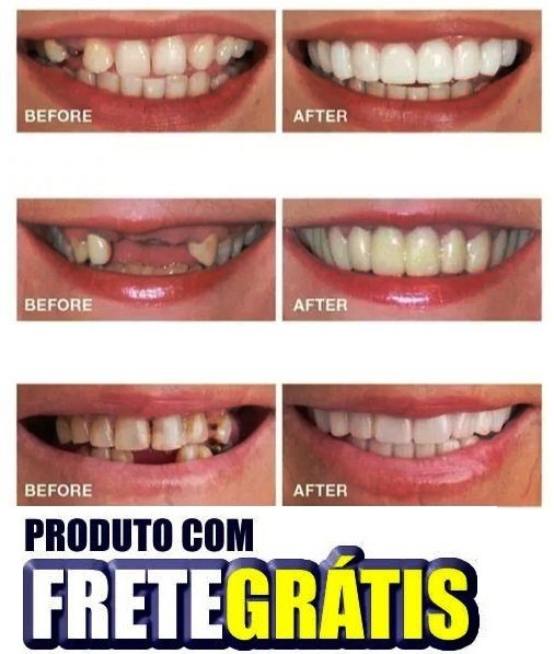 Par Superior E Inferior Snap On Smile Original - R$ 199,00 ... Par Superior E Inferior Snap On Smile Original - R$ 199,00 ...