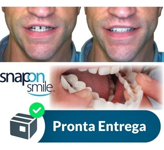 Par Superior E Inferior Snap On Smile Original - R$ 199,00 ... Par Superior E Inferior Snap On Smile Original - R$ 199,00 ...