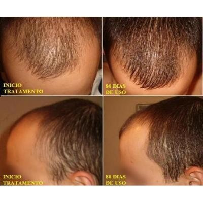 Preço de transplante de cabelo de toda a cabeça