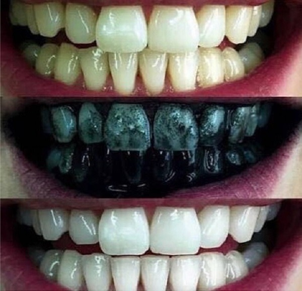 Teeth whitening kit results